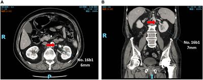 Clinicopathological characteristics and treatment outcome of resectable gastric cancer patients with small para-aortic lymph node